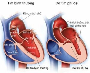 bệnh cơ tim