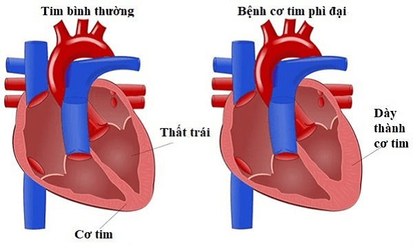 Mô tả bệnh cơ tim phì đại