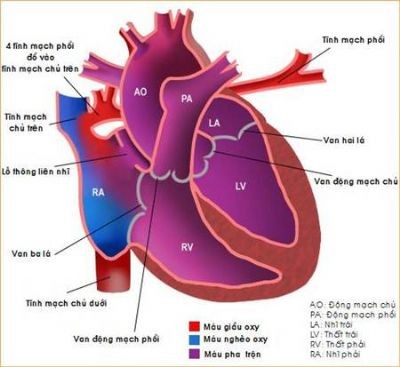 Bất thường hồi lưu tĩnh mạch phổi thể toàn phần