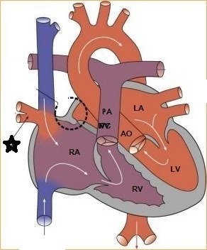 Bất thường hồi lưu tĩnh mạch phổi thể bán phần