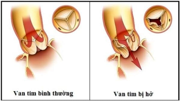 bệnh hở van tim