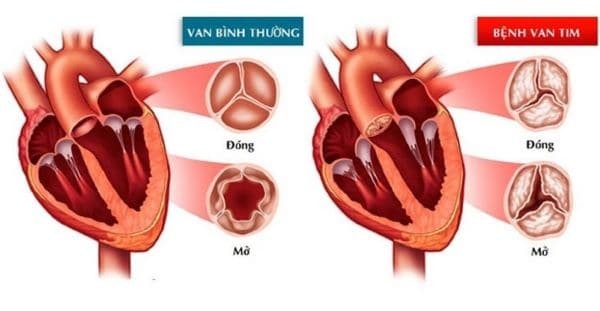 bệnh hở van tim