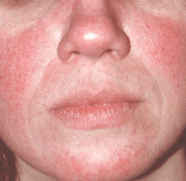 Triệu chứng của bệnh Lupus