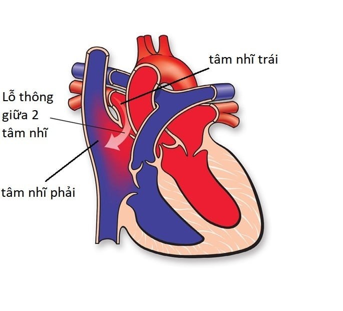 Thông liên nhĩ