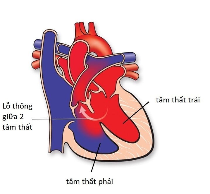 Thông liên thất là khuyết tật bẩm sinh phổ biến nhất của bệnh tim bẩm sinh