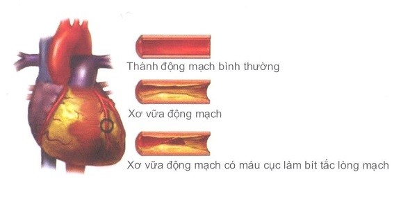 Xơ vữa động mạch vành trong bệnh tim thiếu máu cục bộ mạn tính