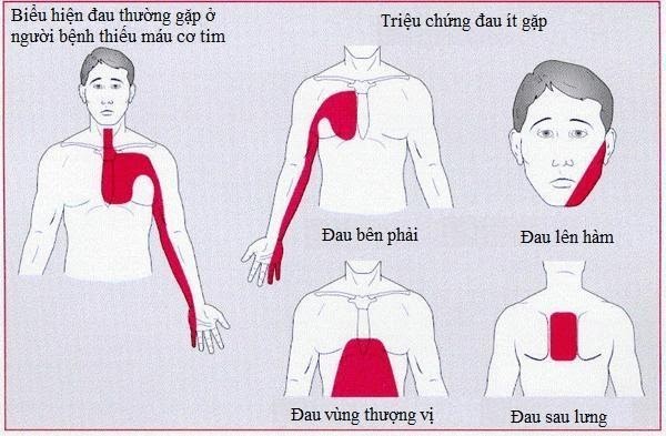 Các vị trí thường gặp của cơn đau thắt ngực