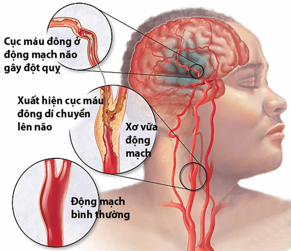 Biến chứng đột quỵ não do tăng huyết áp