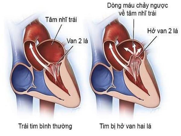 Hình ảnh bệnh tim bị hở van hai lá