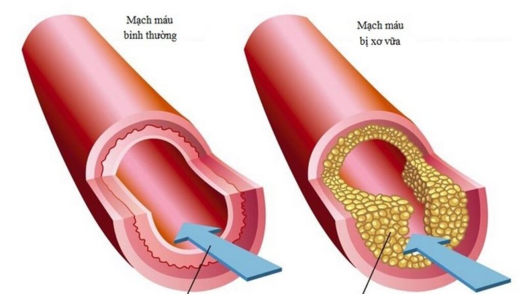 Hẹp lòng mạch máu do xơ vữa