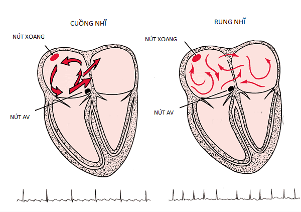 Cuồng nhĩ và rung nhĩ