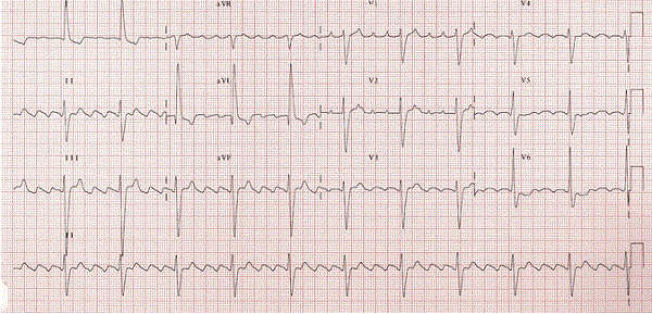 ECG cuồng nhĩ