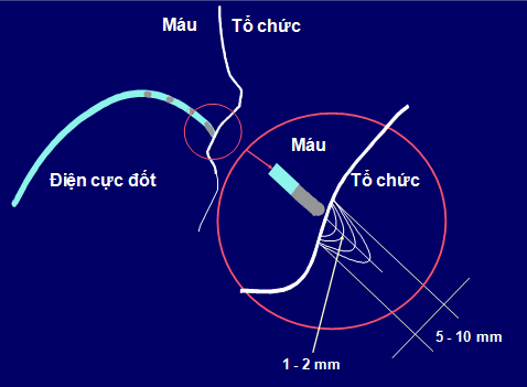 ECG cuồng nhĩ