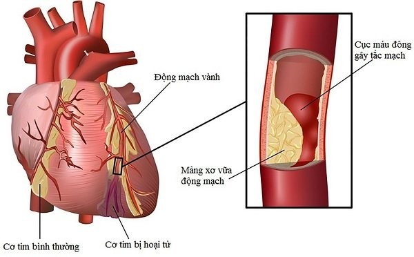 đau ngực