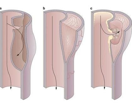 Bóc tách thành động mạch chủ: Máu và huyết tương qua vết loét, tách các lớp thành động mạch rời nhau ra