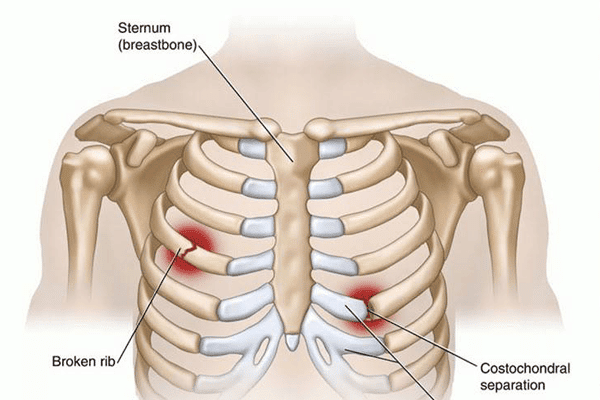 Gãy xương sườn