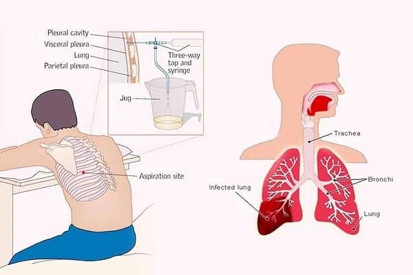 Chọc hút tràn dịch màng phổi