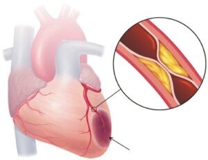 Tắc nghẽn động mạch