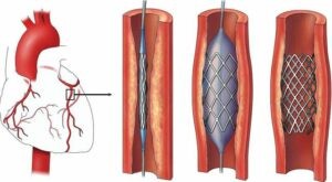 đặt stent