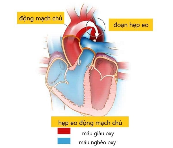 Hẹp eo động mạch chủ