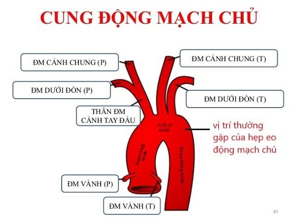 Hẹp eo động mạch chủ