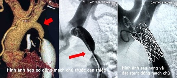 Hẹp eo động mạch chủ