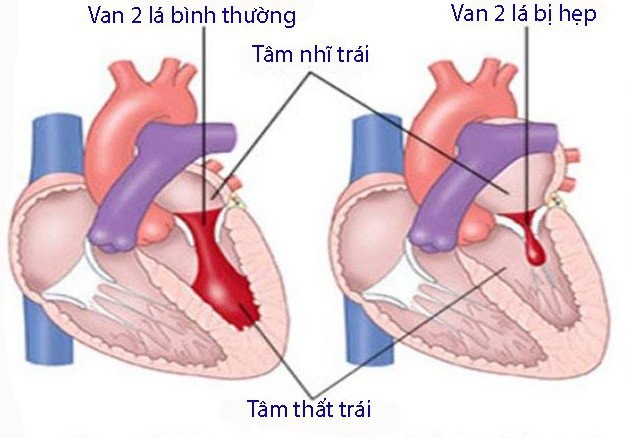 Van 2 lá bình thường và van 2 lá bị hẹp