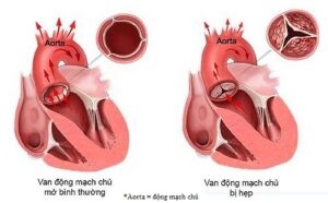 hẹp van động mạch chủ