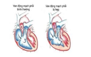 Hẹp van động mạch phổi