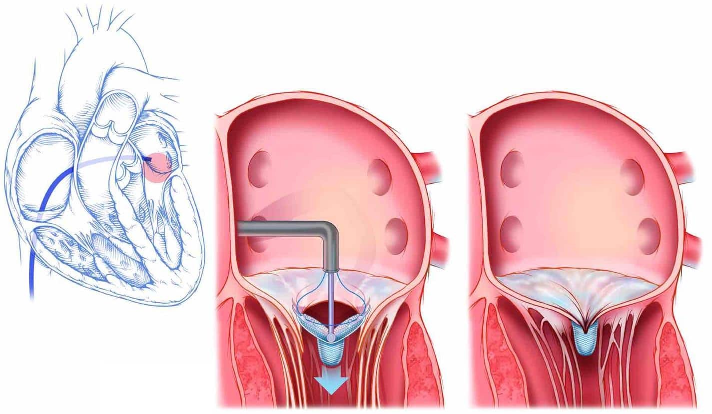 Sửa van hai lá qua da: ống thông được đưa vào nhĩ phải, xuyên qua vách nhĩ và kẹp hai mép van hai lá