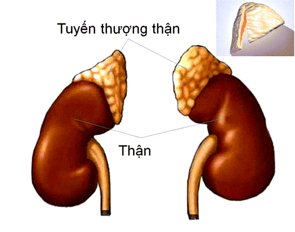 Tăng sản thượng thận vô căn hai bên