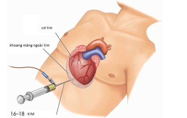 Chọc dịch màng tim