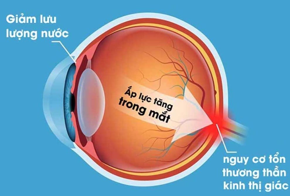 Huyết áp cao ảnh hưởng đến thị lực