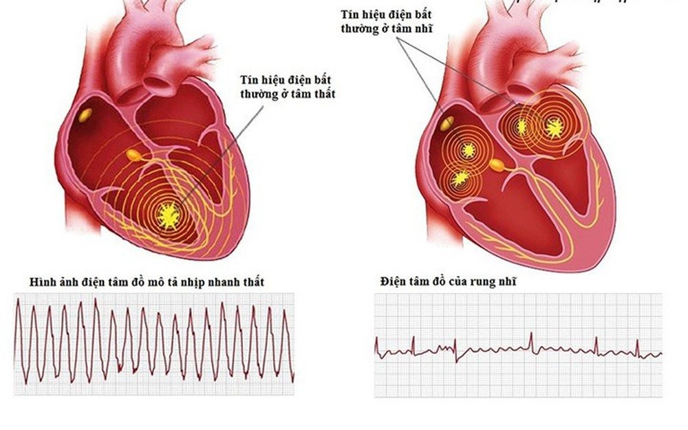 Xung động phát sinh từ tâm thất là nguồn gốc của nhịp nhanh thất