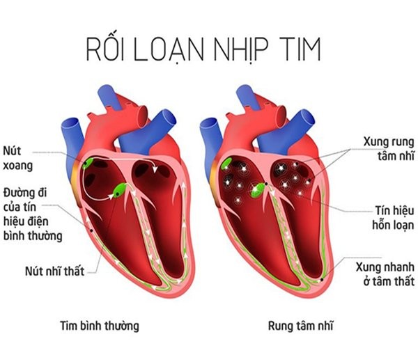 Những nguyên nhân gây rối loạn nhịp tim