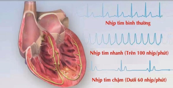 nhịp tim chậm huyết áp thấp