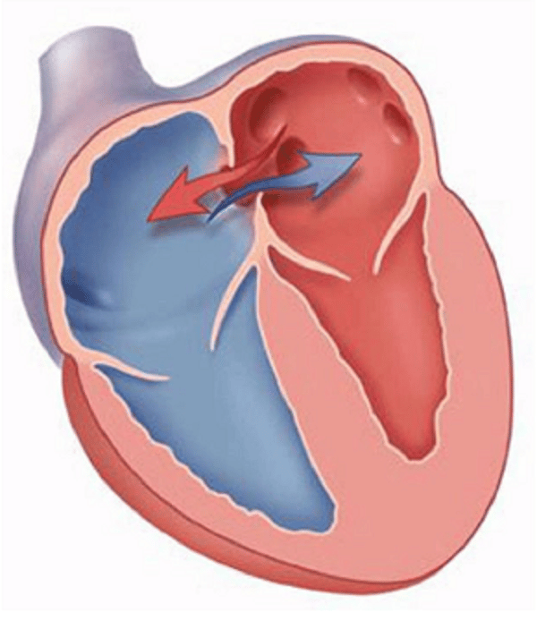 Thông liên nhĩ là dị tật có sự thông thương giữa hai buồng tâm nhĩ ở tim