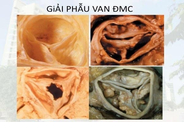 Hẹp van động mạch chủ