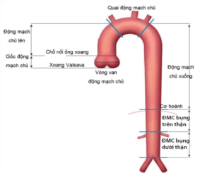 Phình động mạch chủ