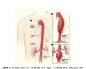 Bệnh phình động mạch chủ