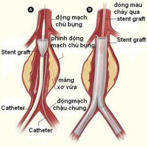 Can thiệp nội mạch phình động mạch chủ