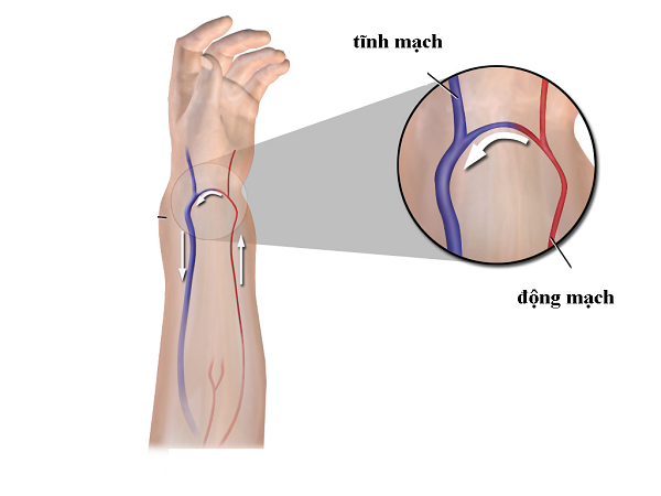 rò động tĩnh mạch