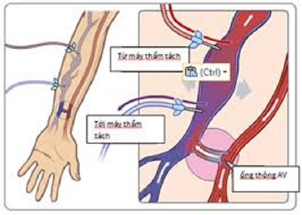 Mổ thông nối động tĩnh mạch