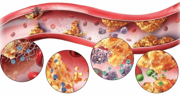  Rối loạn lipid máu là nguyên nhân hàng đầu dẫn đến xơ vữa mạch máu