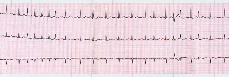 Hình ảnh điện tâm đồ ở người bệnh bị rung nhĩ