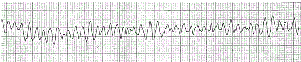 ECG rung thất