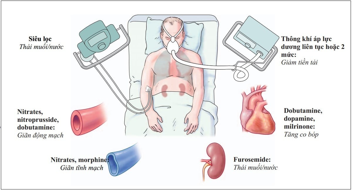 Có nhiều phương pháp điều trị người bệnh suy tim cấp từ cơ bản đến nâng cao