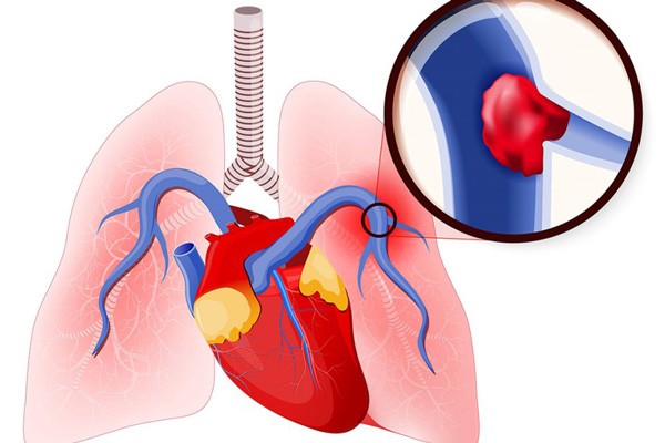 Thuyên tắc phổi