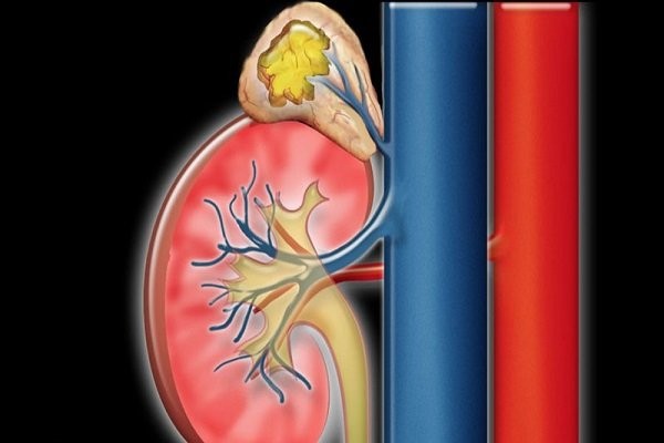 Khối u của tuyến thượng thận có thể dẫn đến huyết áp tăng ác tính