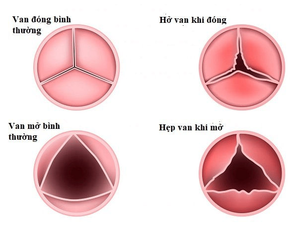  Ở tim, các van tim có thể bị viêm và trở thành sẹo theo thời gian. Hâu quả dẫn đến hẹp hoặc hở van tim, làm cho tim không hoạt động bình thường